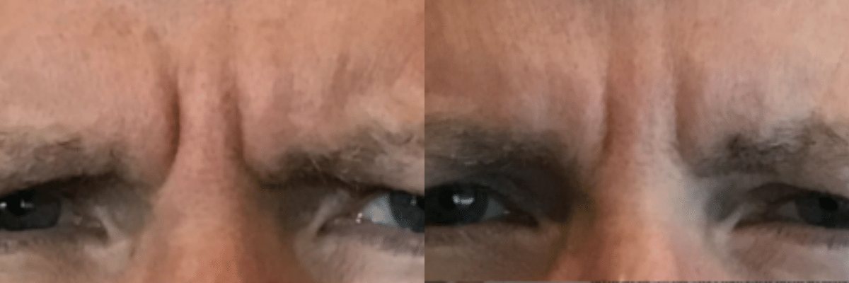 male Botox before and after in forehead