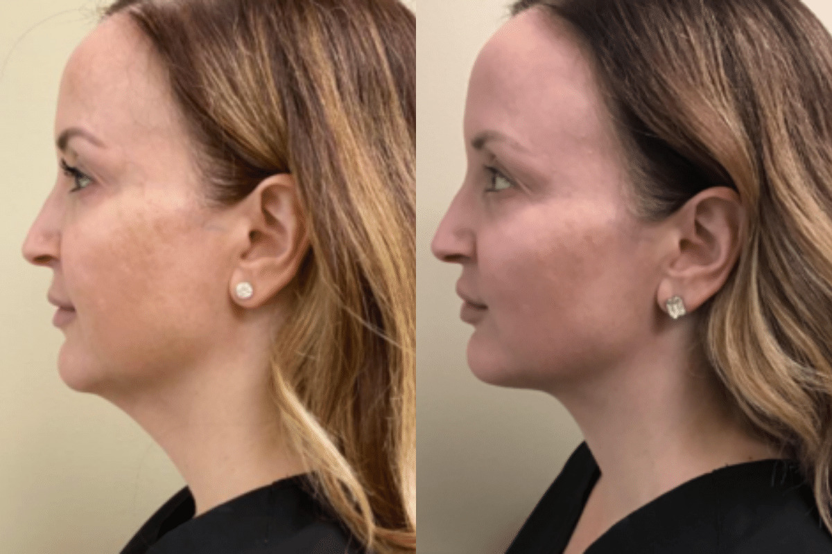 female cheek and jaw side view before and after