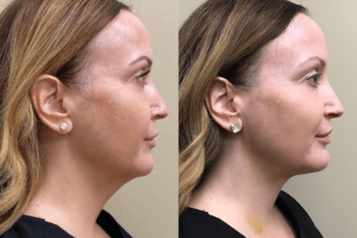 Patient 3551 Cheek and Jaw 2 Front Before and After
