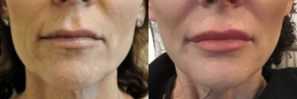 lip plumping transformation for a female patient after receiving injections of Juvederm Vollure, Ultra, and Ultra Plus