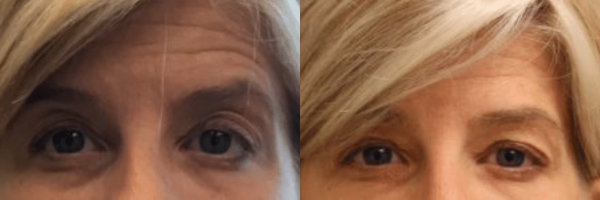female forehead and temples botox Before and After