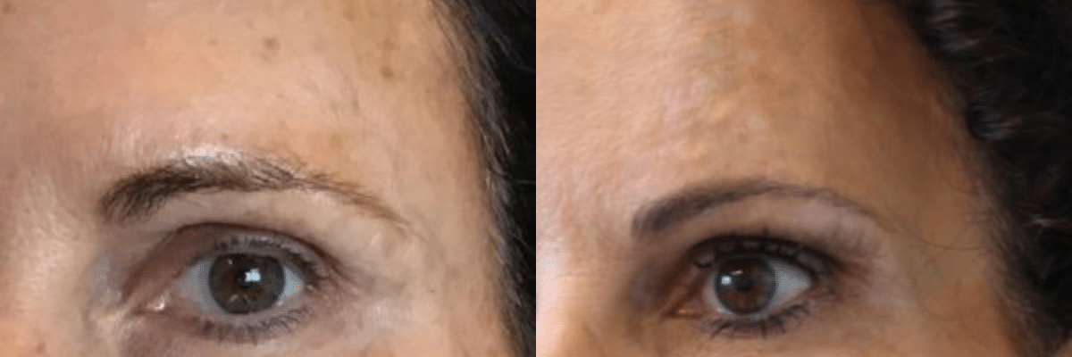 female before and after photos correction for volume loss in temples