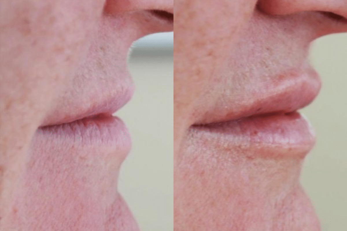 Juvederm Lip Augmentation before and after