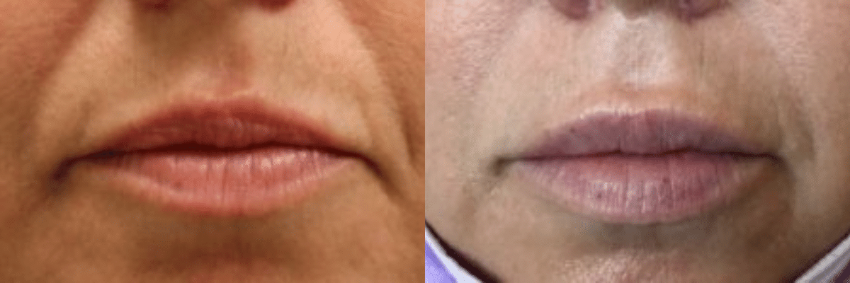 female Vollure lip augmentation before and after