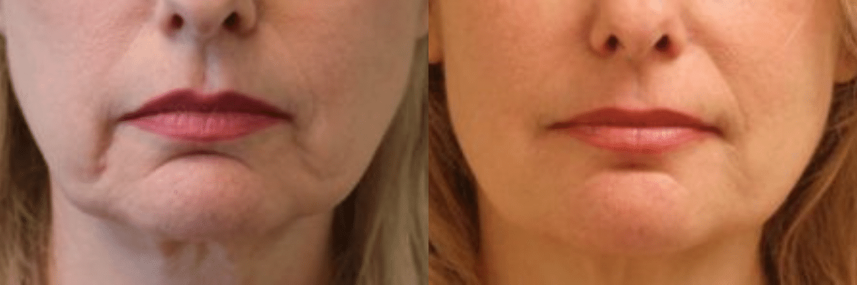 female marionette line correction with Juvderm Vollure before and after