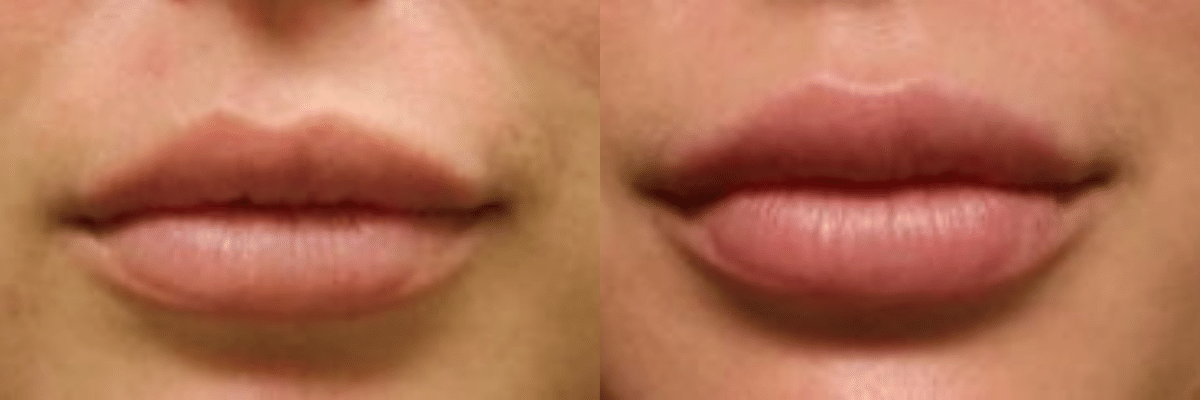 female Juvederm Volbella Lip Enhancement Before and After