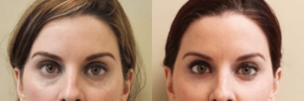 Juvederm Voluma Undereye Treatment Year 1 Before and After