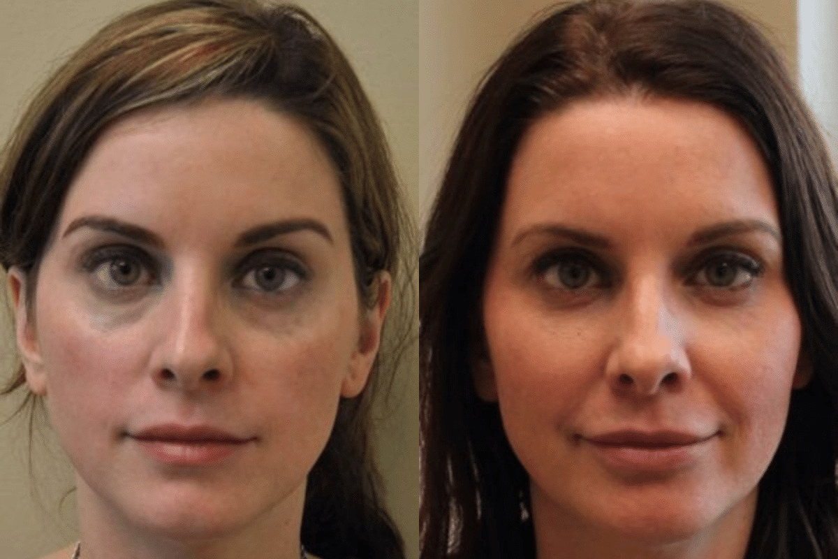 Juvederm Voluma Undereye Treatment Yr 2 Before and After