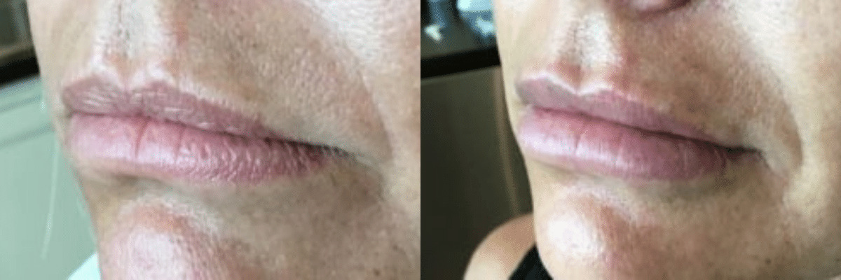 before and after li augmentation photos female patient using Juvederm Ultra Plus injections