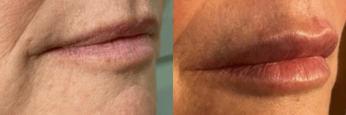 Patient 3595 Restylane Kysse Lip Augmentation Before and After