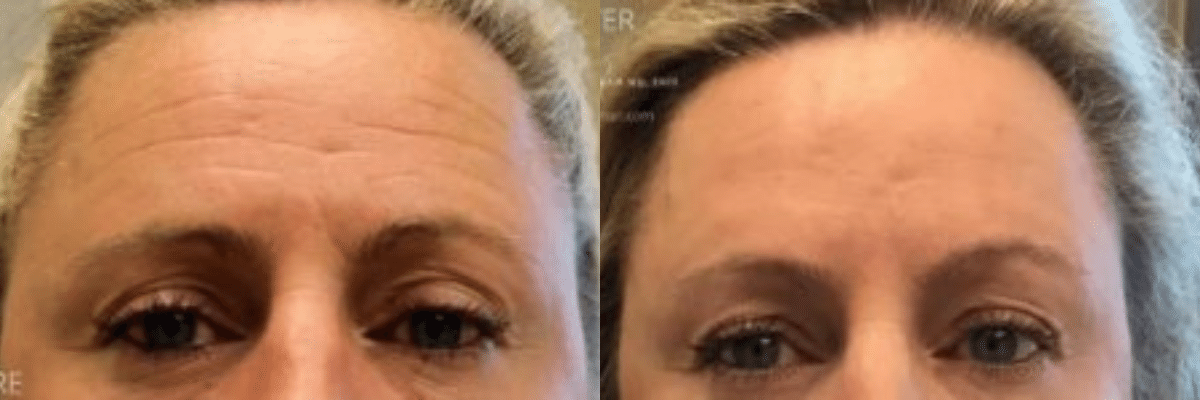 Botox before and after photos show the amazing change in our female patient’s forehead
