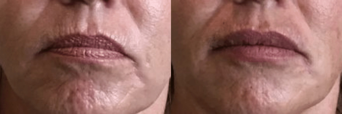 Juvederm Vollure Lip Augmentation Before and After female patient