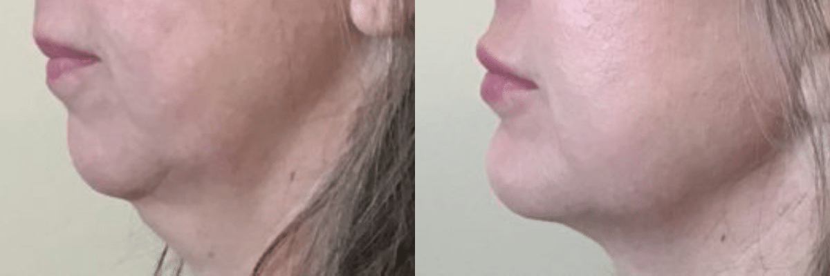 Female Juvederm Chin augmentation before and after