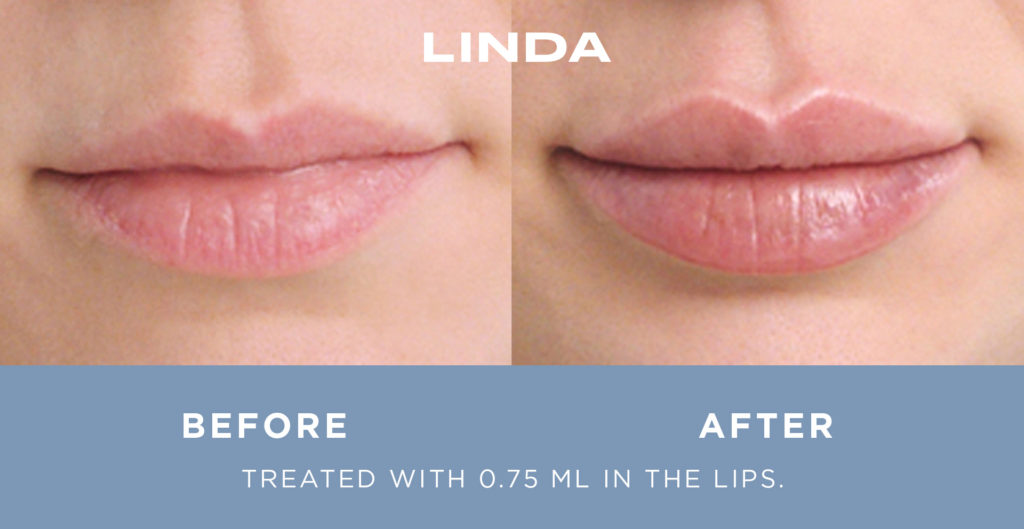 Restylane Kysse Before and After for Linda