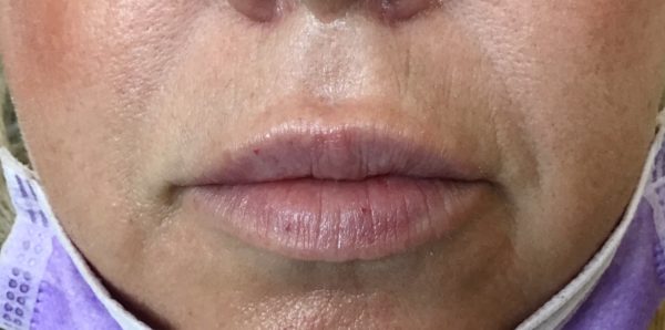 Vollure Lip Augmentation - After