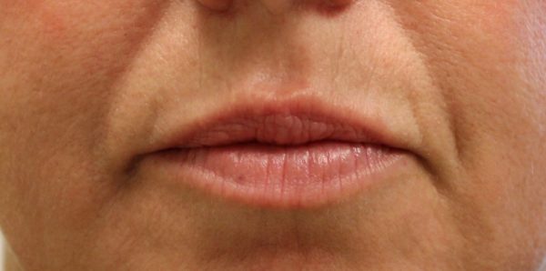 Vollure Lip Augmentation - Before