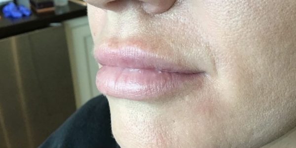 Lip Augmentation Before Photo