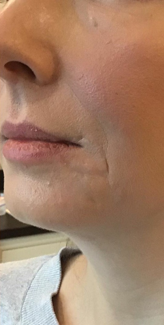Filler Treatment After Photo