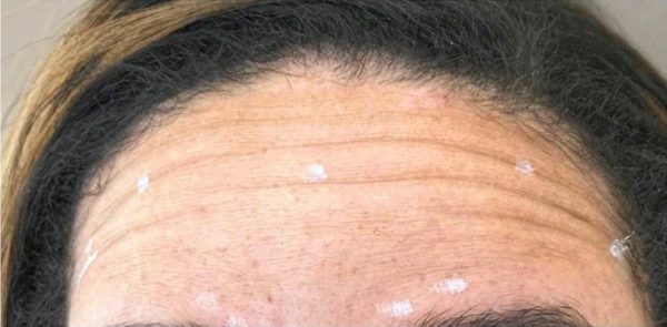 Botox Forehead Frown Line - Before