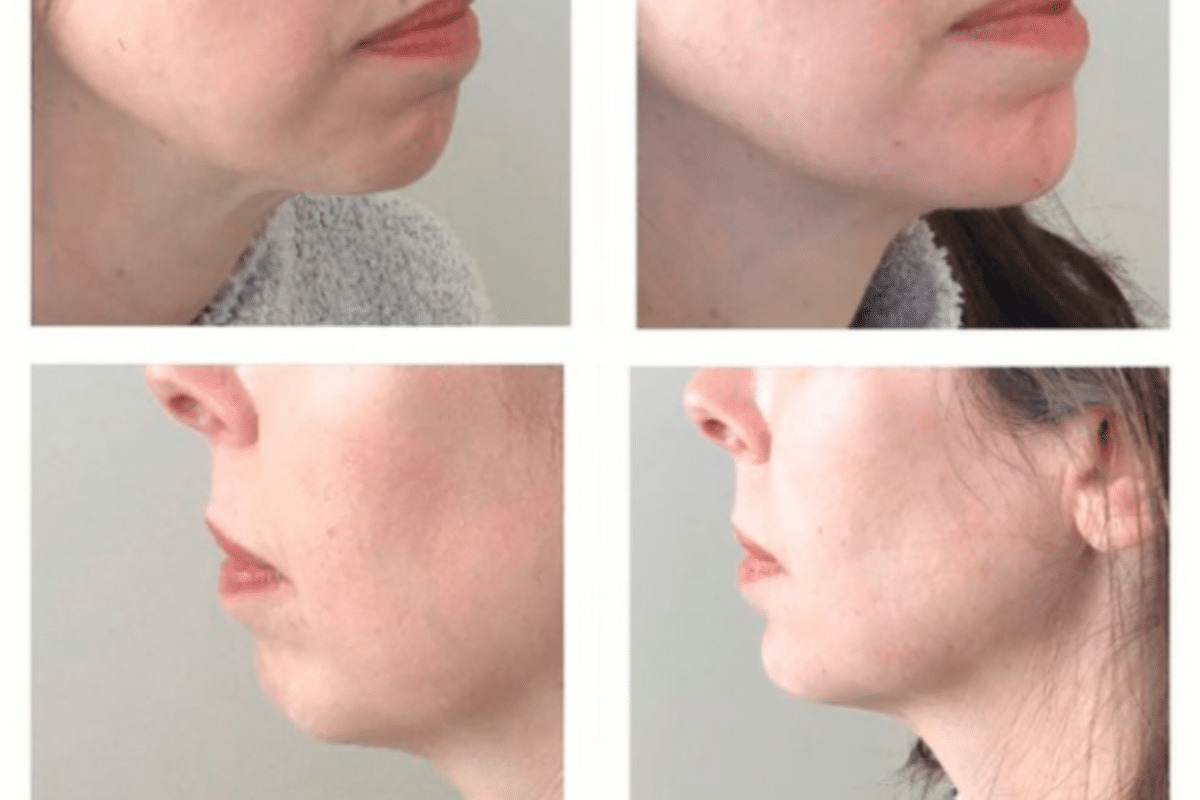 female chin augmentation procedure using Juvederm Voluma with a microcannula