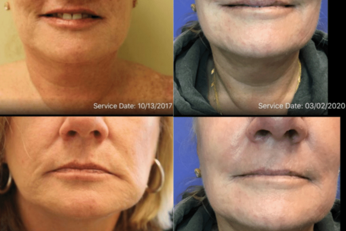 Female patient before and after photos for filler treatments targeting marionette, chin, and jaw