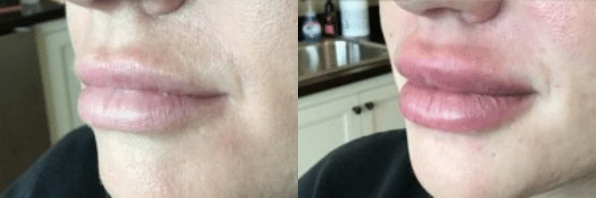 female lip filler before and after