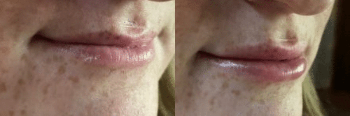 before and after photos of a Kysse lips filler plumping treatment in female