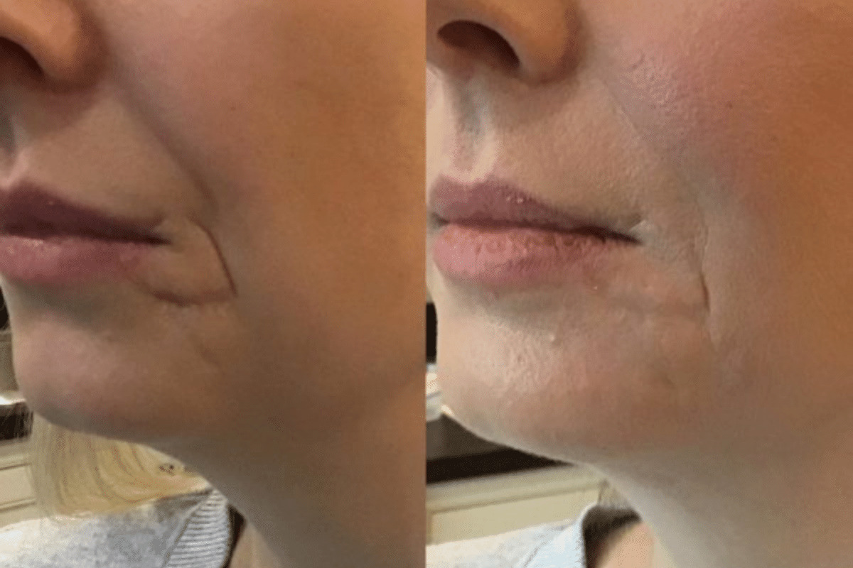 Before and after photos for a female client’s filler treatment