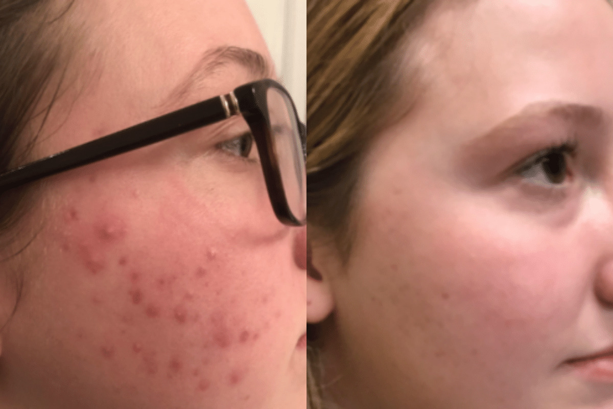 female before and after forever clear BBL treatment for acne.