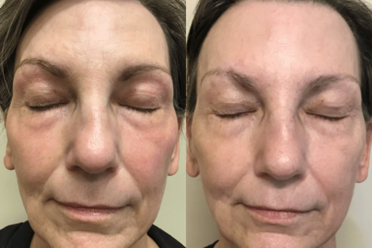 female patient before and after subnovii treatment