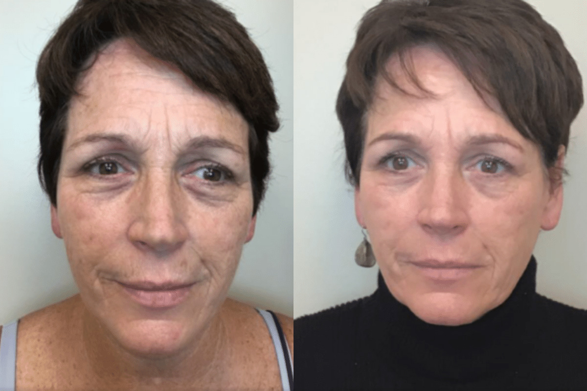 female patient before and after subnovii treatments 1 month post treatment