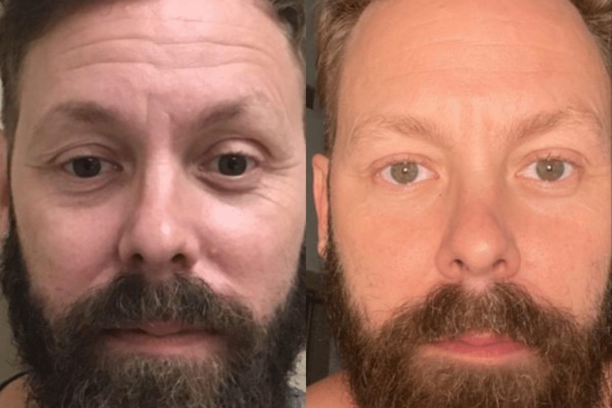 male before and after one week after subnovii treatment