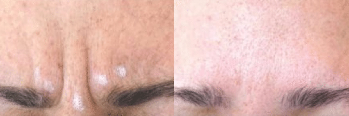 male botox frown before and after