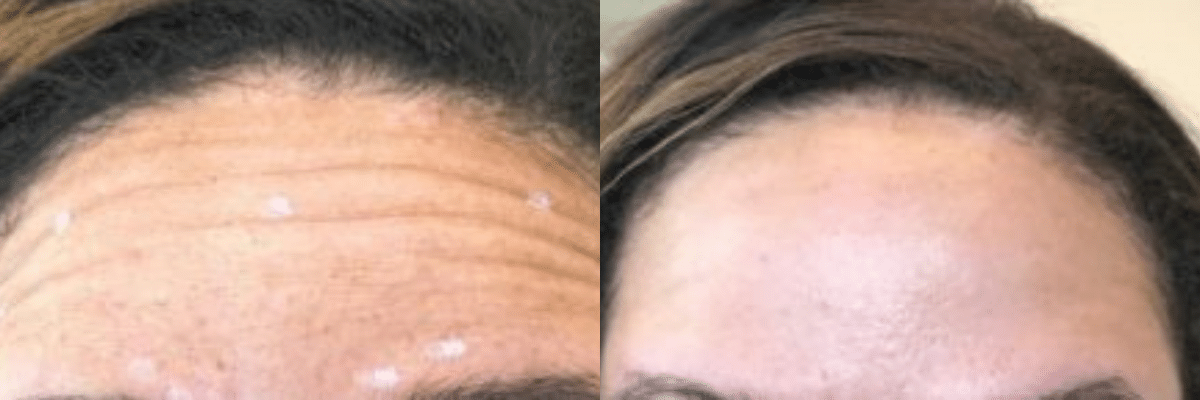 Patient 3777 Botox Forehead Frown Line Before and After