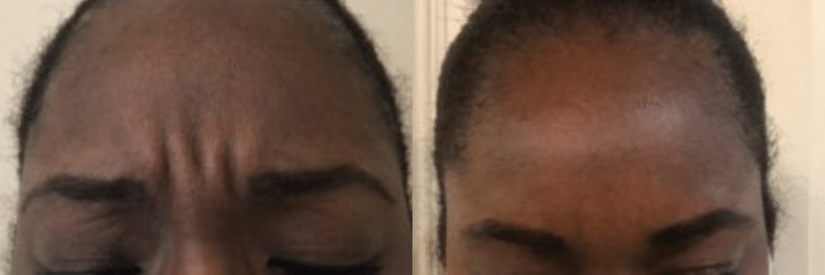male patient frown line correction before and after