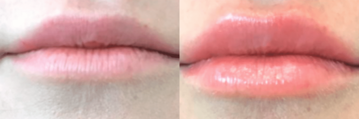 female Restylane Kysse lip augmentation before and after