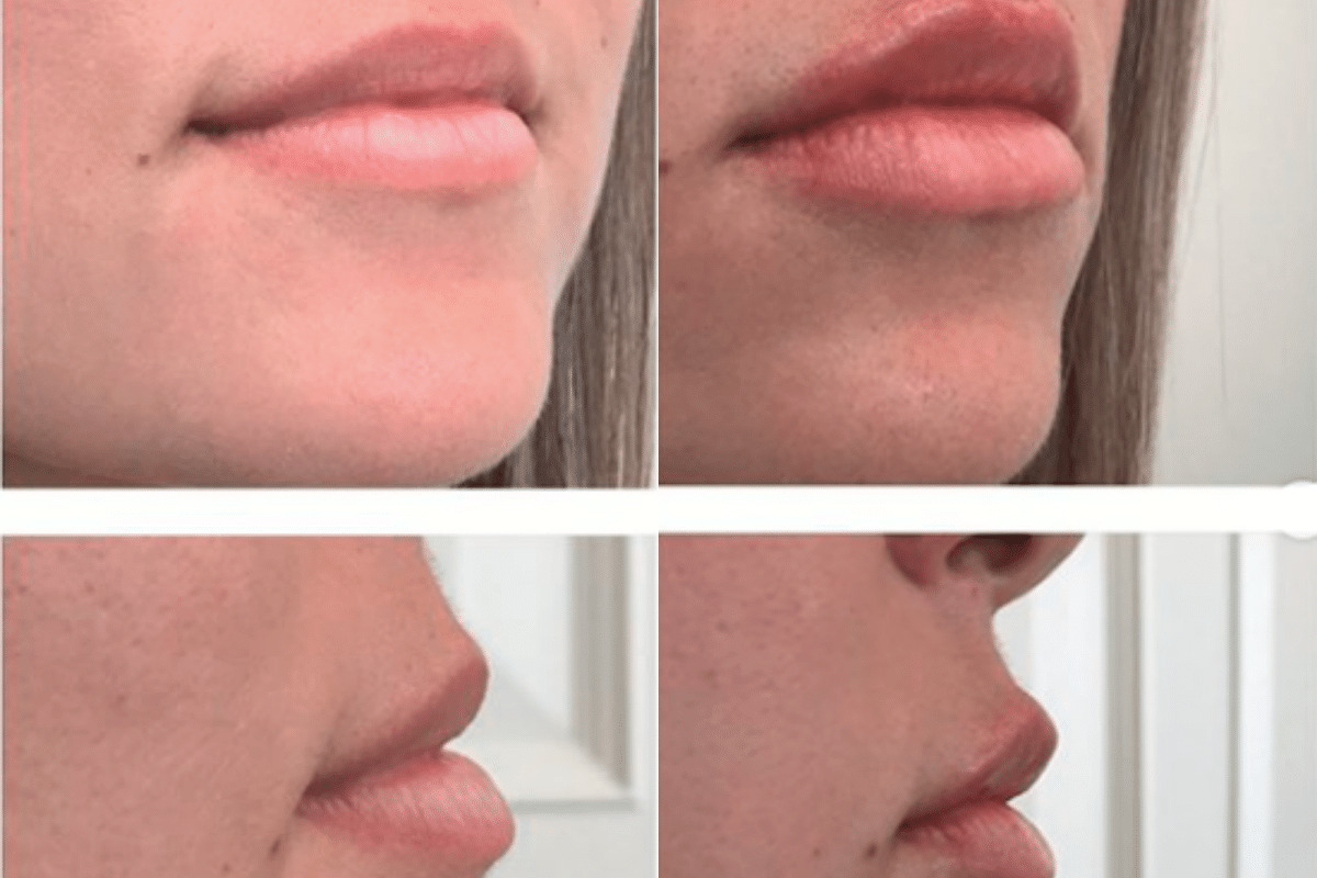 Patient 3790 Restylane Kysse Lip Augmentation Patient 2 Before and after