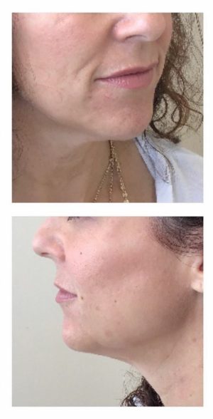 Injectable and Filler Before and After Photos