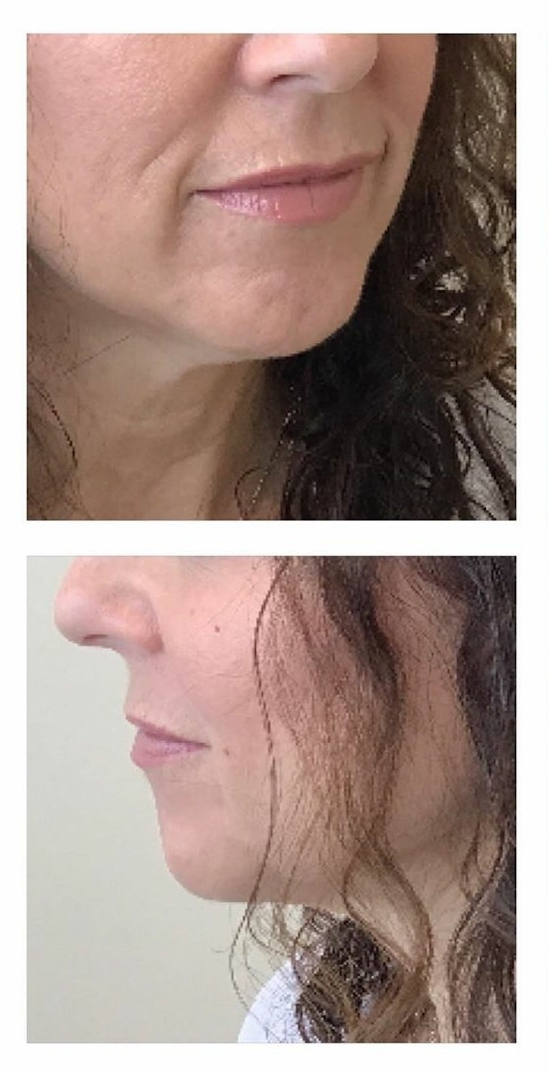 Chin Augmentation and Marionette Line Correction - Before