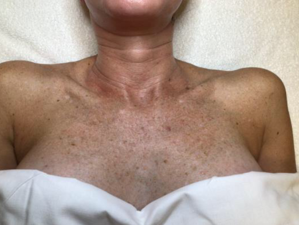 IPL Photofacial Before and After of the Chest - Before