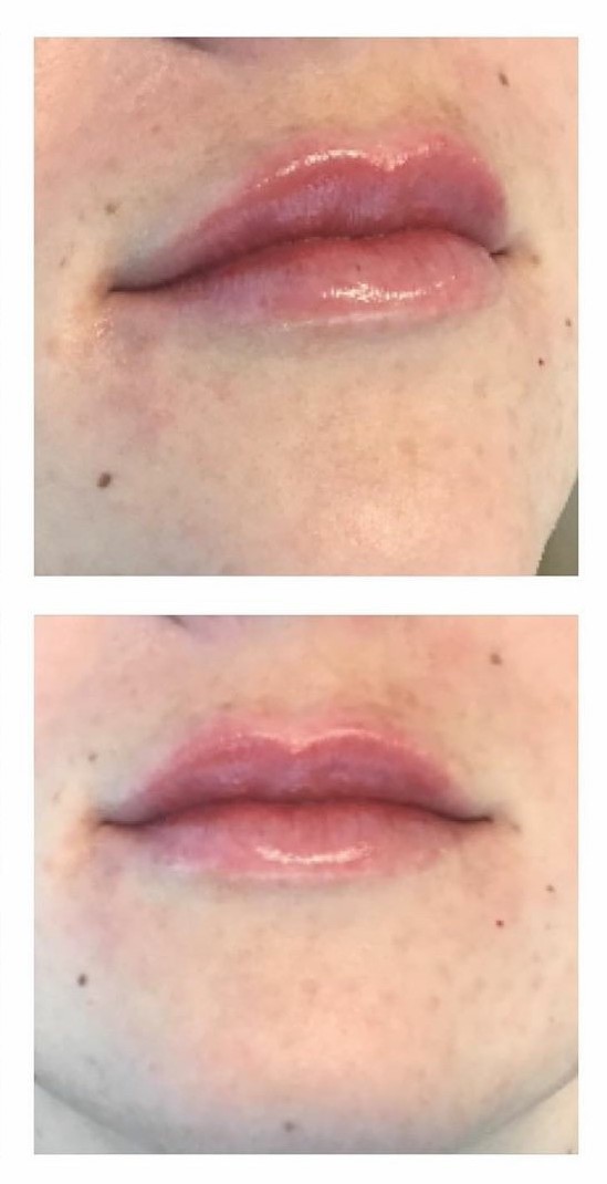 Juvederm Ultra Lip Augmentation After Treatment