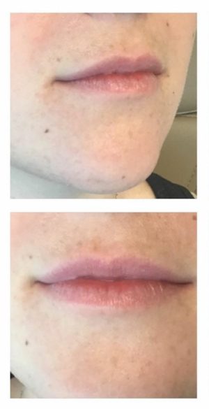 Injectable and Filler Before and After Photos