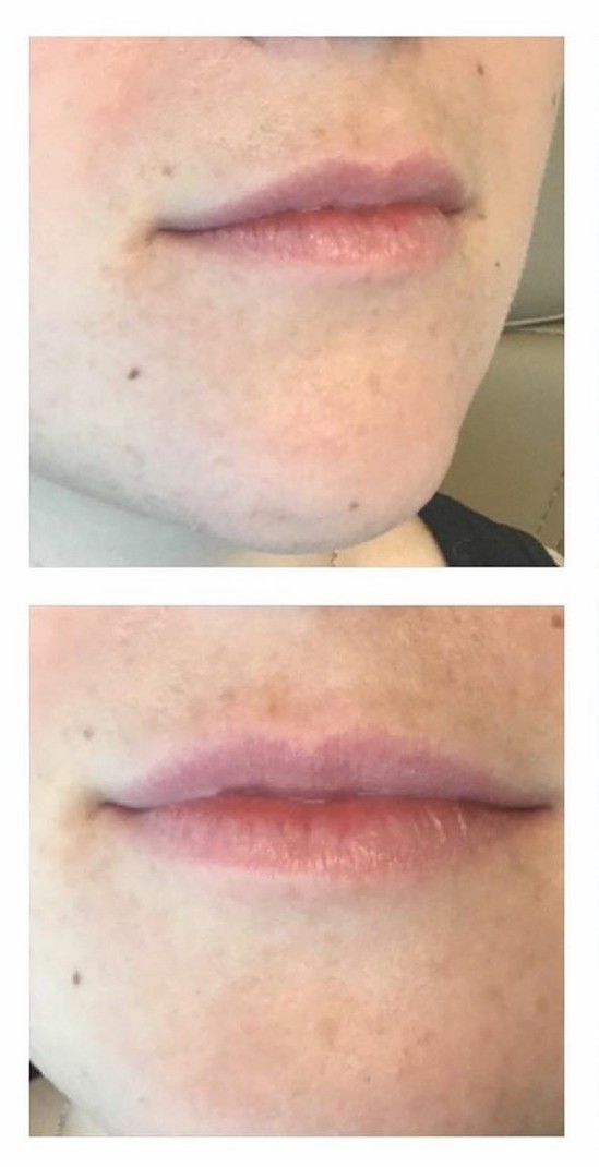 Juvederm Ultra Lip Augmentation Before Treatment