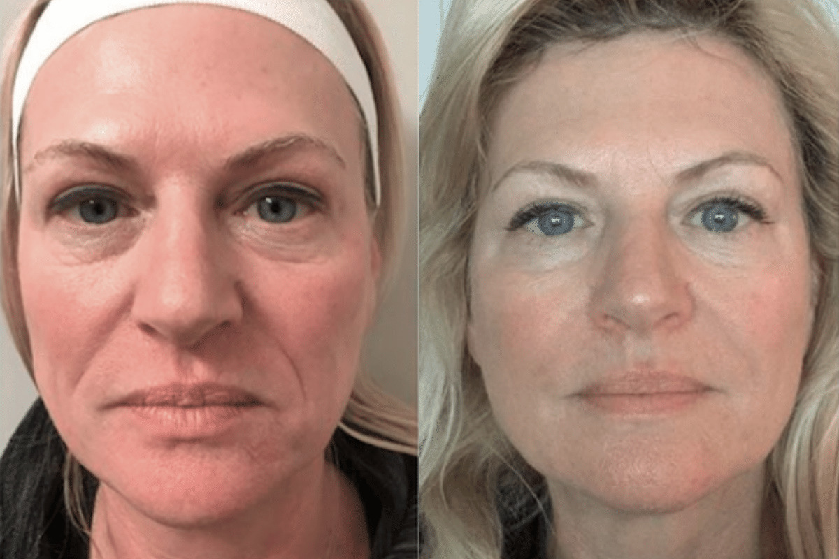 female patient liquid facelift before and after