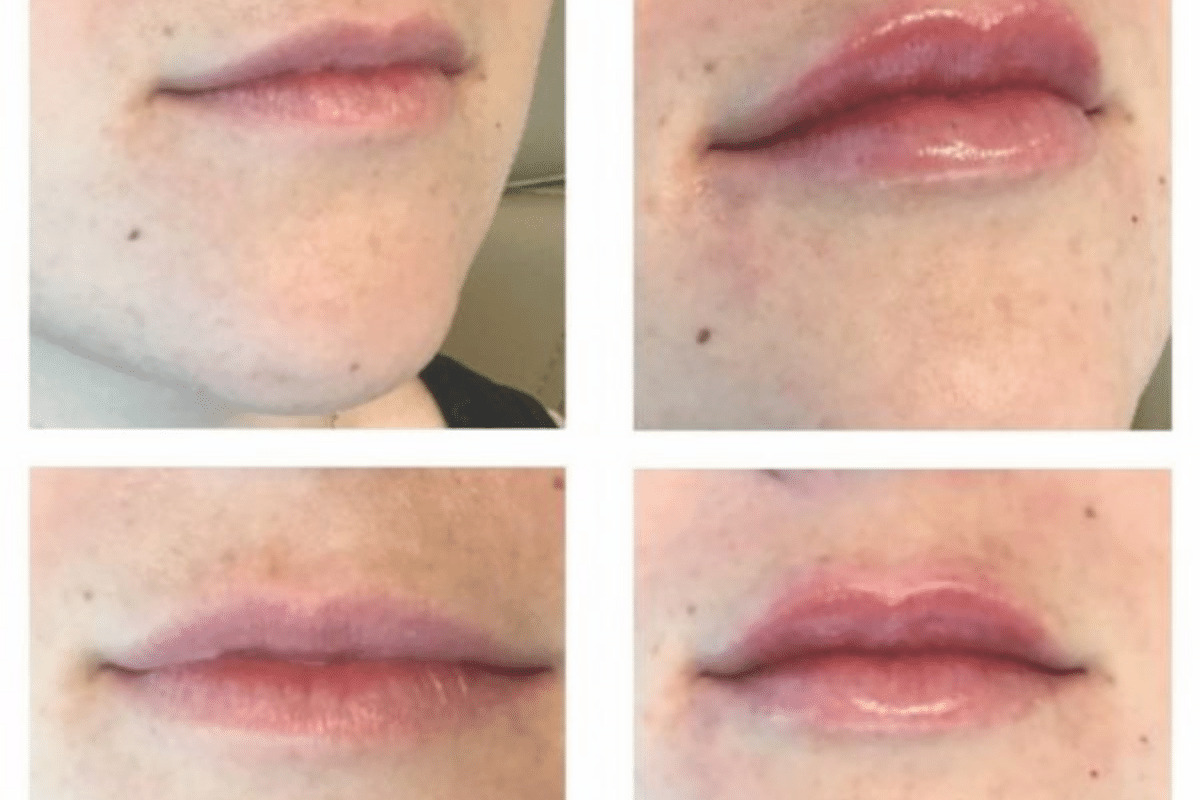Juvederm Ultra Before and After lips