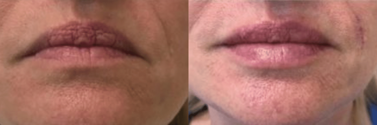 female patient Juvederm lip augmentation before and after