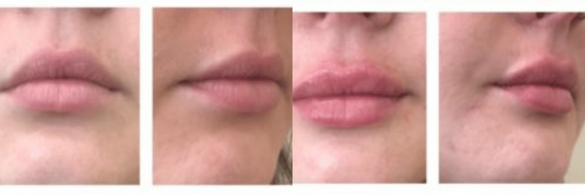 four before and after pics of female dermal fillers lip augmentation