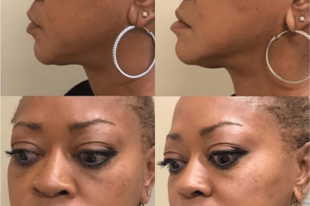 Cheek and Jowls Correction Before and After