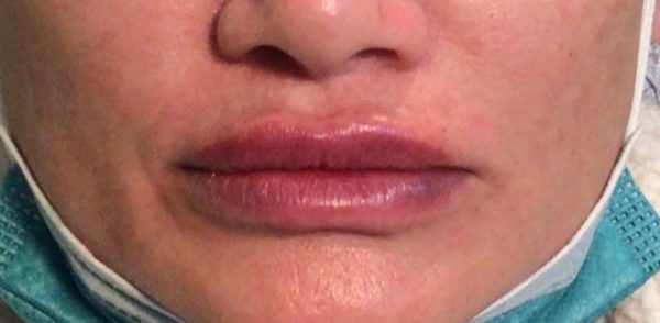 Juvederm Vollure Lips Front - After