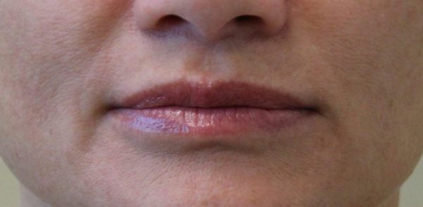 Juvederm Vollure Lips Front - Before